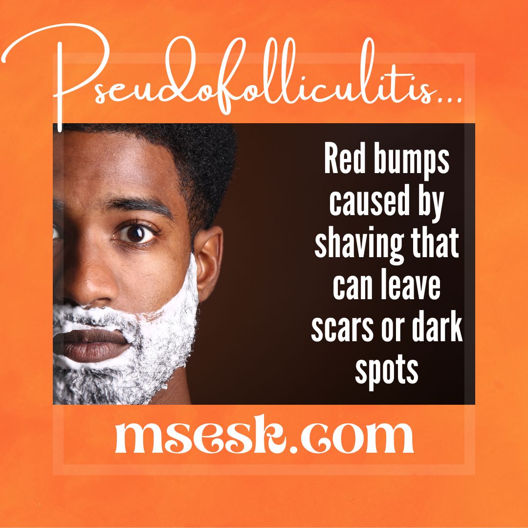 I finished my #page on #pseudofolliculitis - it is most common in my Black patients from #shaving the #hair too close to the #skin - I include #helpfultips - msesk.com/medical-secret…

#blackskin #blackskincare
#medicalsecrets #msesk #dermatology @UtahDerm @ZachHopkinsMD