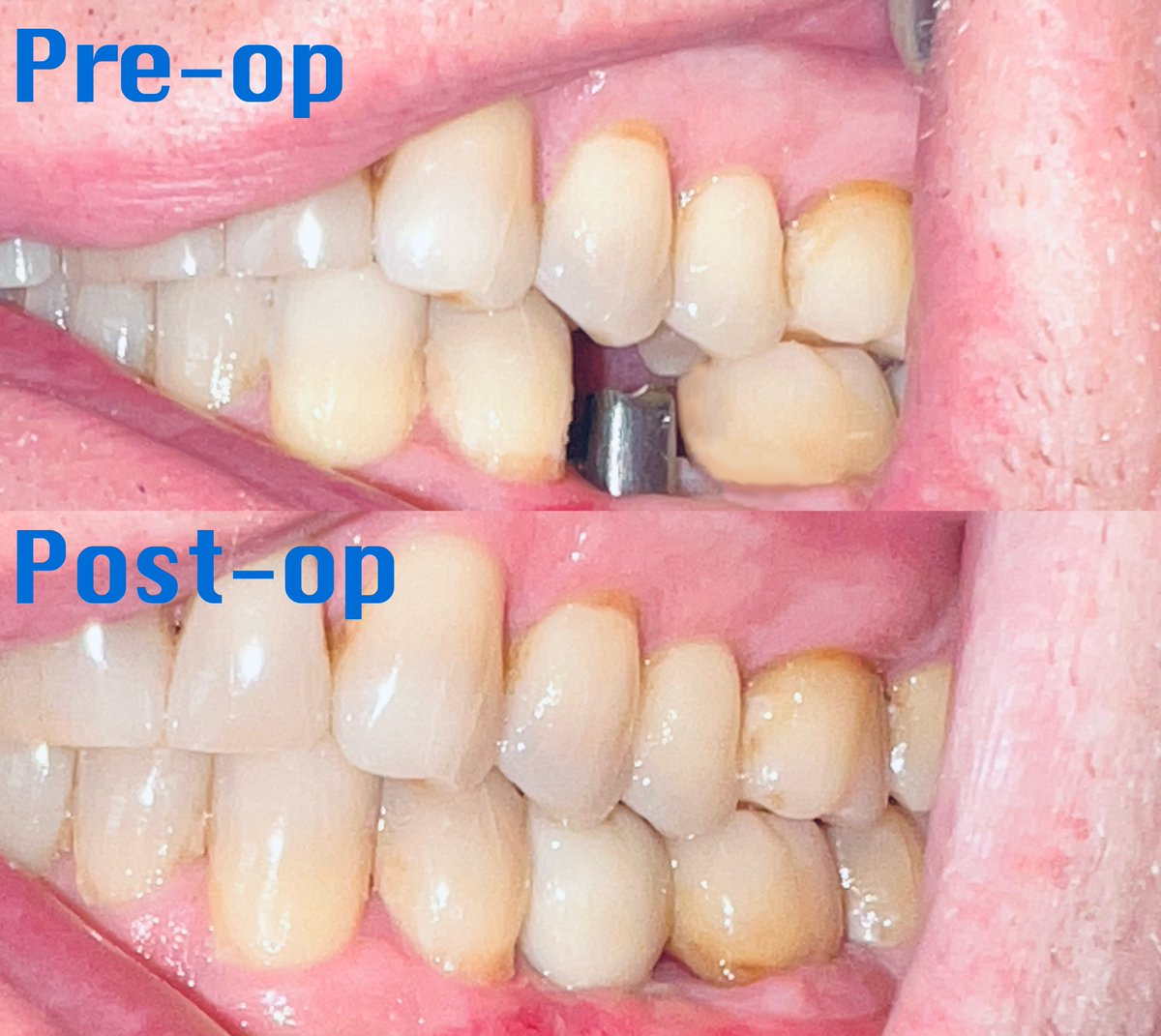 cdic_dmd's tweet photo. Howard R. Came to our office with a baby tooth still in the mouth which he wanted to replace with implant retained crown. Look at the results! 

#dentistry #charlotte_dentist #RameshSunar #DrRush #cosmeticdentist #affordable_Implants  #implant #center #doctor  #dentistry #teeth https://t.co/xoS4yhfrYx
