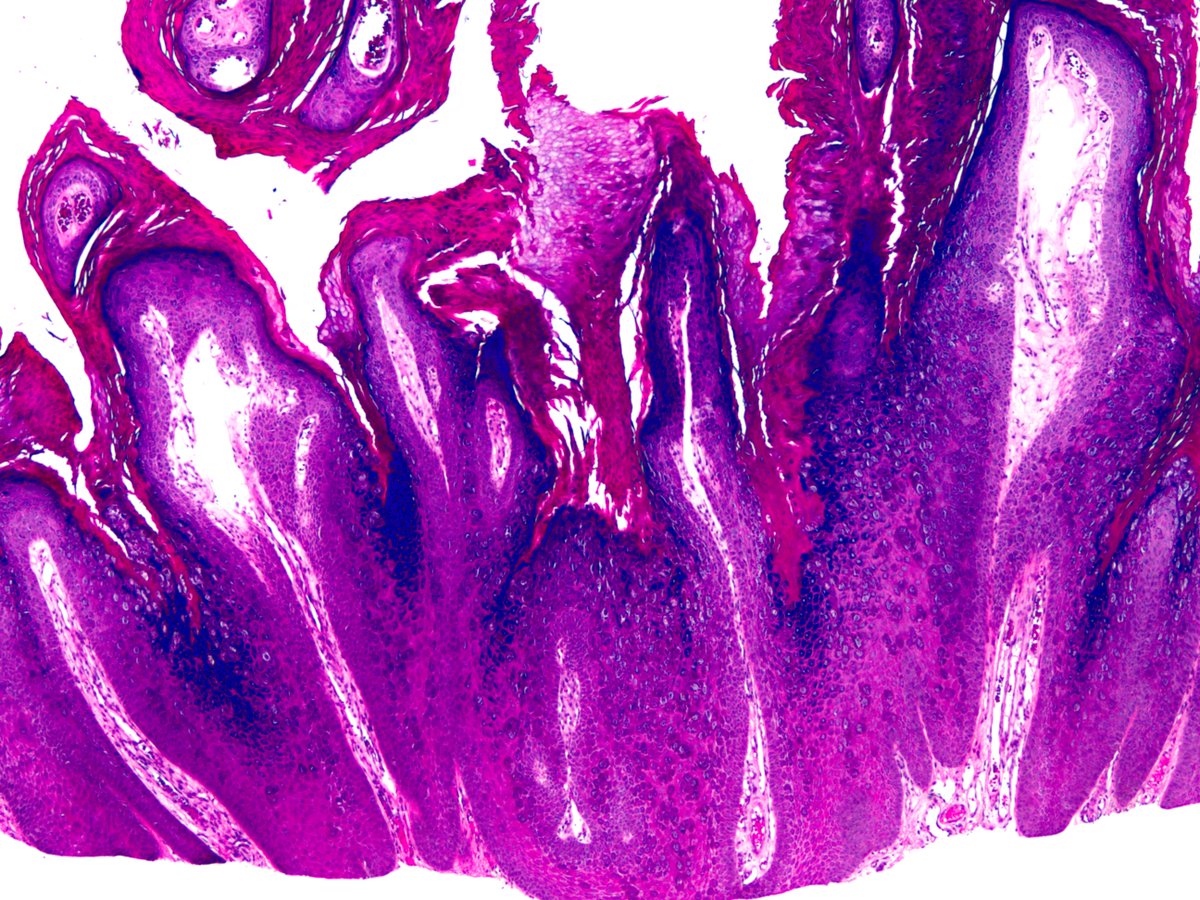 smlungpathguy's tweet photo. This wart is named after an ant: Myrmecia, shaped like an anthill, named after the bulldog ant https://t.co/TzI6JeDYU4 https://t.co/AXbMJNjo5v