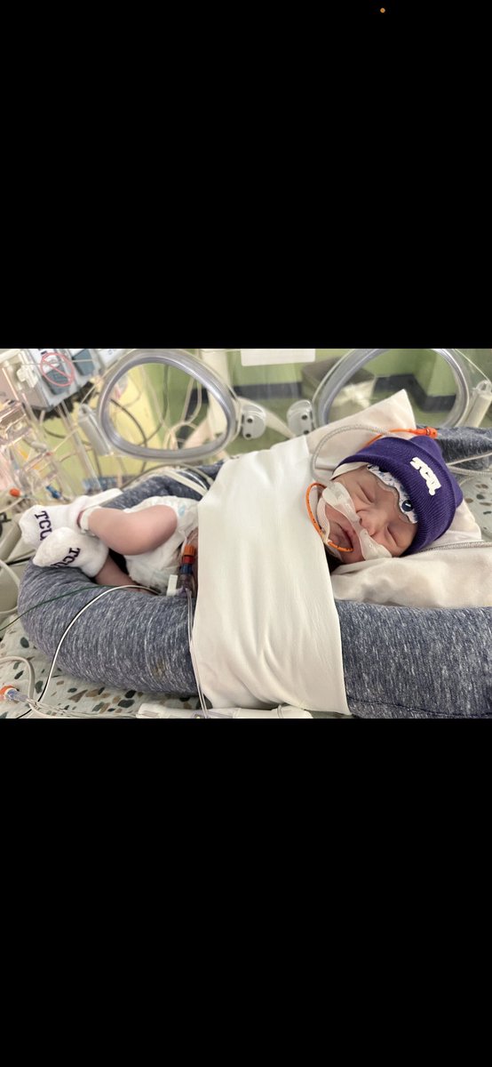 Krista 🩷 (@krishooten) on Twitter photo The smallest TCU fan and our little HLHS warrior. <a href="/TCUFootball/">TCU Football</a> Go Frogs 💜💜🏈👶🏻 #AndrewRay The smallest TCU fan and our little HLHS warrior. <a href="/TCUFootball/">TCU Football</a> Go Frogs 💜💜🏈👶🏻 #AndrewRay