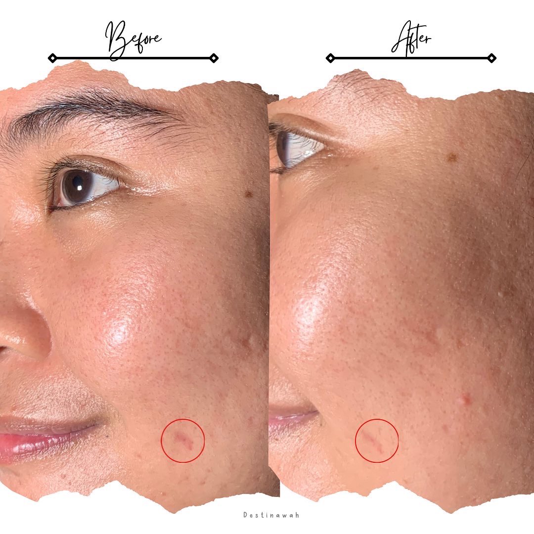 destinawah's tweet photo. [Gentle dan Minim Iritasi, Cobain THE ORIGINOTE Retinol B3 Serum]

Kalian bucin retinol apa masih pemula retinol? Sini mendekat, aku punya racun baru retinol yang gentle dan minim iritasi dari @theoriginote 👀✨. Yuk kita bahas aja!

#racuninskincare #reviewbydestinawah https://t.co/DVisui2QIj