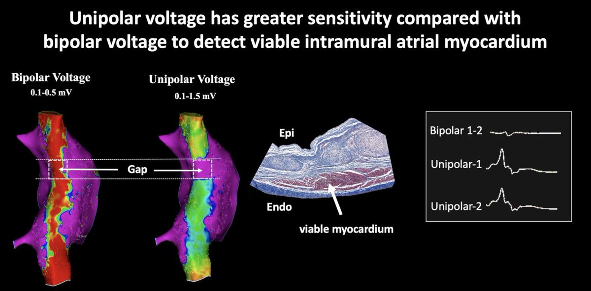 CircEP (@circulationep) on Twitter photo Atrial unipolar voltage has greater sensitivity compared with bipolar voltage to detect viable intramural and epicardial myocardium in the presence of endocardial scar <a href="/yavinh/">yavinh</a> <a href="/arwayounis2/">Arwa Younis MD</a> <a href="/BarkaganMichael/">Michael Barkagan</a> @eladanter #AHAJournalshttps://doi.org/10.1161/CIRCEP.122.011321 Atrial unipolar voltage has greater sensitivity compared with bipolar voltage to detect viable intramural and epicardial myocardium in the presence of endocardial scar <a href="/yavinh/">yavinh</a> <a href="/arwayounis2/">Arwa Younis MD</a> <a href="/BarkaganMichael/">Michael Barkagan</a> @eladanter #AHAJournalshttps://doi.org/10.1161/CIRCEP.122.011321