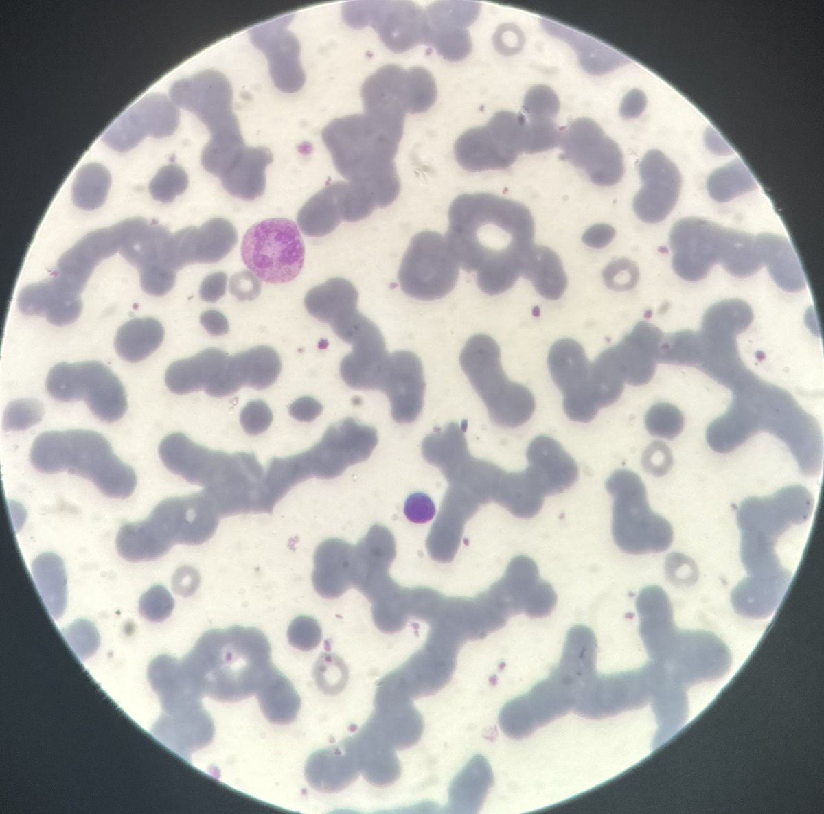 Patient with WM has 180k WBC but they are missing in the blood film! Repeat testing shows similar findings. 

Where are they!? What’s going on!? 
#Lymsm #Blooducation <a href="/xitlalygzz/">Xitlaly Gonzalez</a>