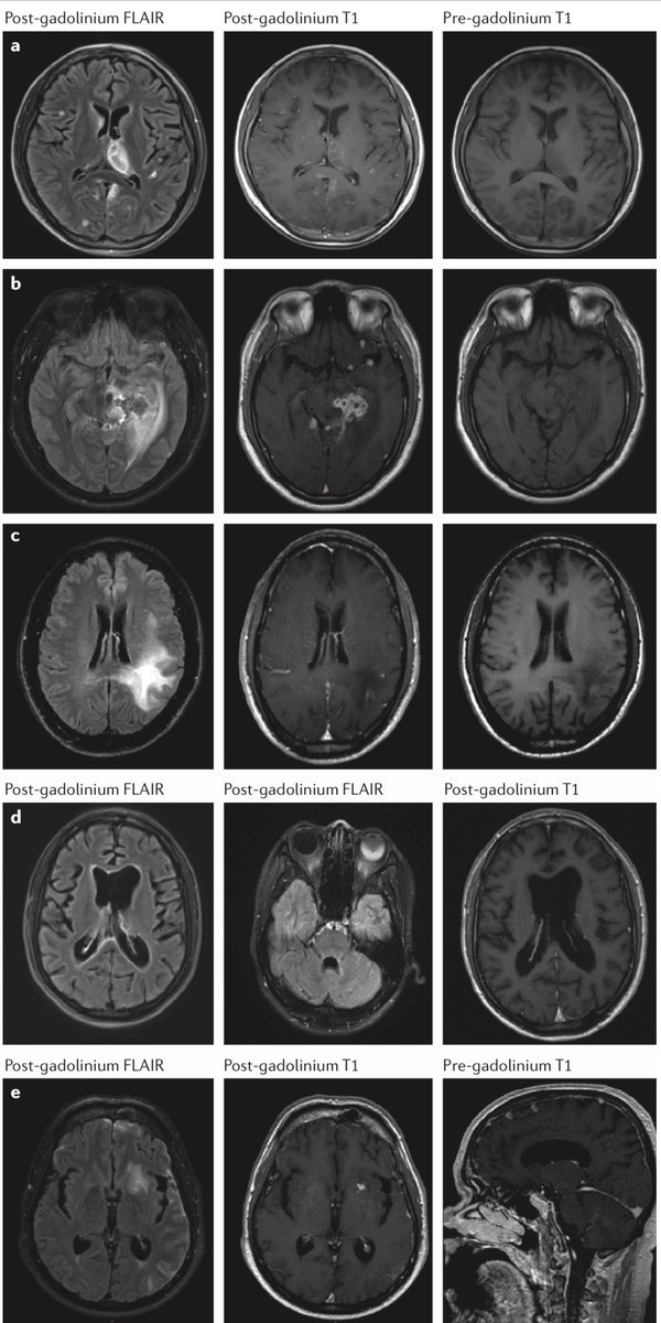 AmbrizMau's tweet photo. Hallazgos en RM de infecciones oportunistas en pacientes con VIH:
a) Encefalitis por toxoplasma
b) Meningitis tuberculosa
c) Leucoencefalopatía multifocal progresiva
d) Encefalitis por citomegalovirus
e) Meningitis criptocócica

Nat Rev Neurol 2016; DOI: https://t.co/MHMj00drb1 https://t.co/ctjKJr1lAw