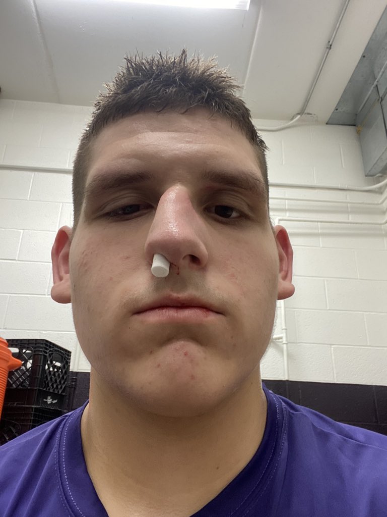 JohnsKaiden's tweet photo. Not exactly the way I wanted to end my practice today. #ERtrip #broke #whichwaydidmynosego https://t.co/xFeY8R3jBO