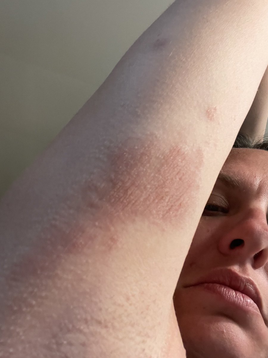 Candida8181's tweet photo. @JohnPeate5 @sunlorrie I had this reaction to the vaccine! Almost 2 years later and it still flares! Please tell me it’s a short term allergic reaction again! https://t.co/wJHqlbaExr