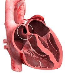 An atrial septal defect is a birth defect of the heart in which there is a hole in the wall (septum) that divides the upper chambers (atria) of the heart. A hole can vary in size and may close on its own or may require surgery.