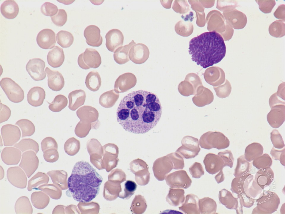 Check out these 2 neutrophil morphologies👇🏻

Image 1: Botyroid neutrophil
Image 2: Hypersegmented neutrophil

1. Looks like a bunch of 🍇 around a central stem, the number of segments can be as high as 9 😮

2. Hypersegmented neutrophils don't have >6 segments

#MedTwitter #MedEd