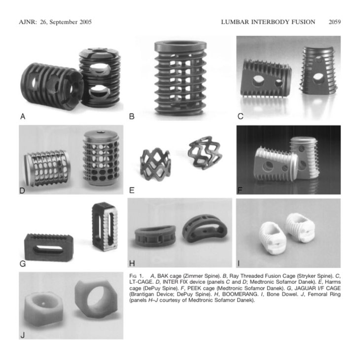 Revision cases in spine often requires to look back at the history of interbody fusions. #Spine #orthotwitter #Neurosurgery