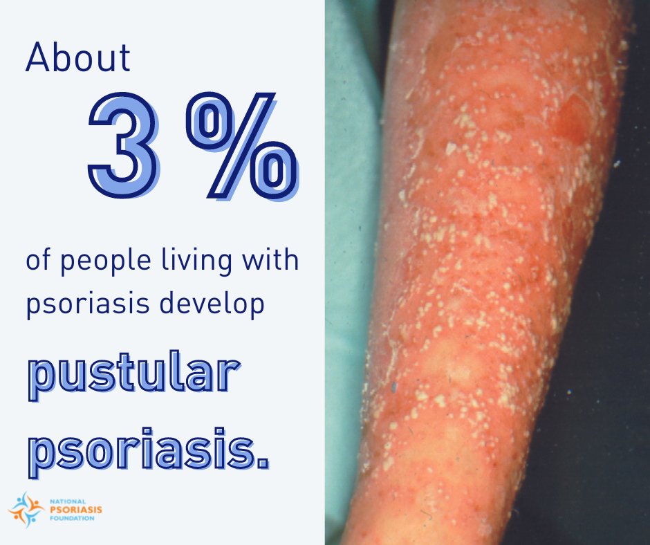 NPF's tweet photo. Pustular [PUHS-choo-lar] #psoriasis include pustules (white or yellow, pus-filled, painful bumps) that may be surrounded by inflamed or reddened/discolored skin. Learn more about types and treatments for #pustularpsoriasis : https://t.co/qRAzIyXnwk https://t.co/fq6PrnhZoE