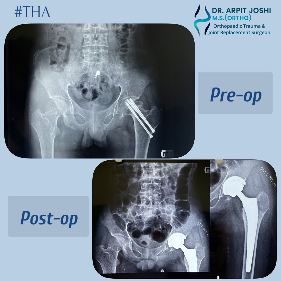 arpit_avj's tweet photo. Total Hip Replacement ( થાપાનાં સાંધાનું પ્રત્યારોપણ) #THR #HipReplacementSurgery #Orthopaedics #Arthroplasty https://t.co/tVKDi3rApu