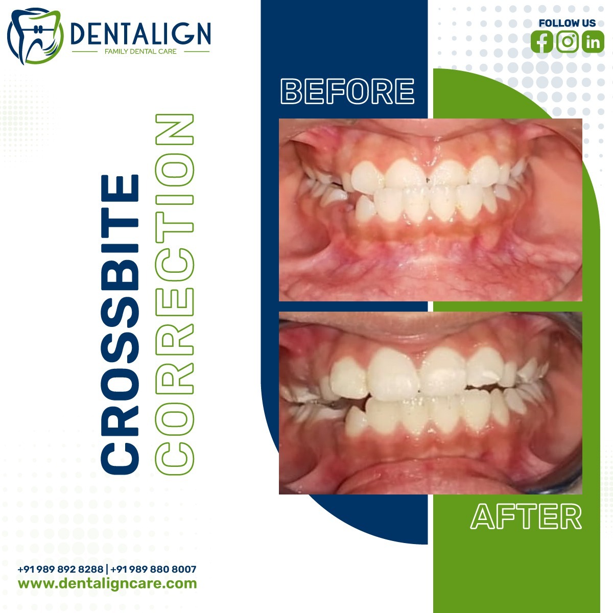 #Crossbite to Normal Bite with a #CrossbiteCorrection treatment. If you're looking for a reliable, effective way to correct your crossbite - look no further than the treatment offered at Dentalign! 

#orthodontics #teeth #adultbraces #smile  #clearbraces #teethstraightening