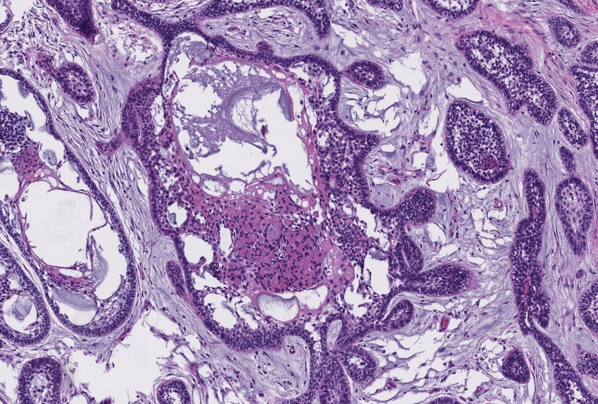 Patient presents with a painless swelling of the mandible. X-ray shows an expansile, multilocular lesion. Diagnosis? What is the most common site for this entity? Answer and pearls in the comments! #PathTwitter #ENTpath #MedEd