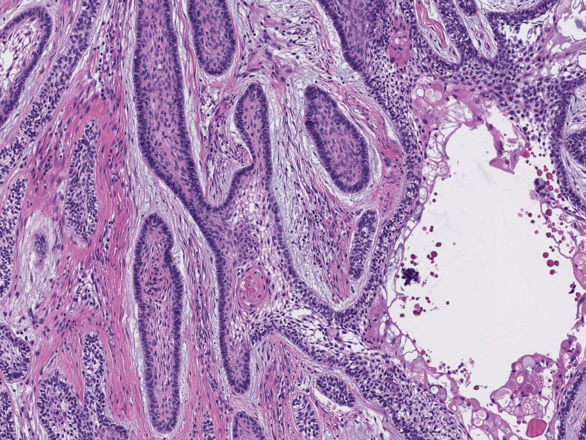ihartpathology's tweet photo. Patient presents with a painless swelling of the mandible. X-ray shows an expansile, multilocular lesion. Diagnosis? What is the most common site for this entity? Answer and pearls in the comments! #PathTwitter #ENTpath #MedEd https://t.co/tDBjXyWxDe