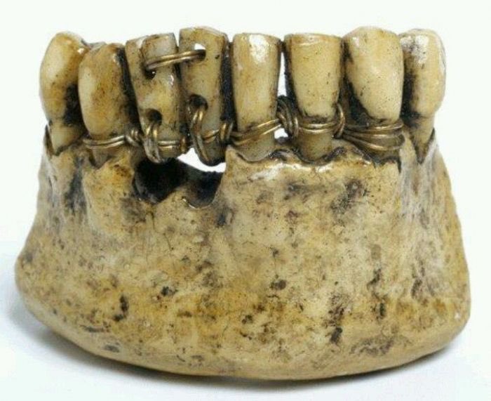 HowardFarran's tweet photo. Egyptian mummies were discovered with braces and dental implants. 4,000 years ago, Egyptians were performing dental surgeries. Teeth lost to decay were replaced with donor teeth from humans or animals, and wire was wrapped around the other teeth to keep them upright and in place. https://t.co/NjVUb7kFvQ