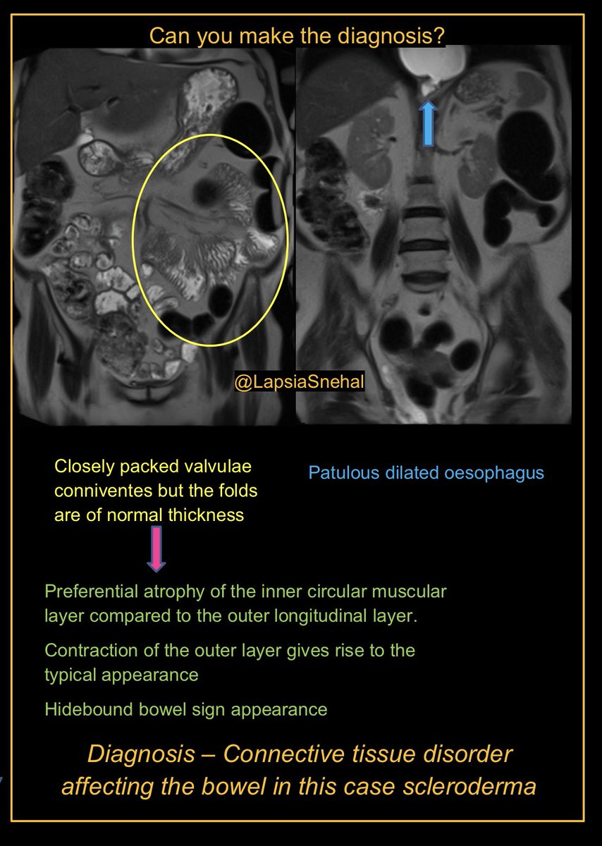 Fold pattern interrogation is essential when evaluating the small bowel. #FOAMrad #FOAMed #meded  #radres #futureradres #medstudenttwitter #gitwitter #anatomy #frcr #surgery #radiology #radtwitter #medtwitter #smallbowel #gastro #gastroenterology #abdrad