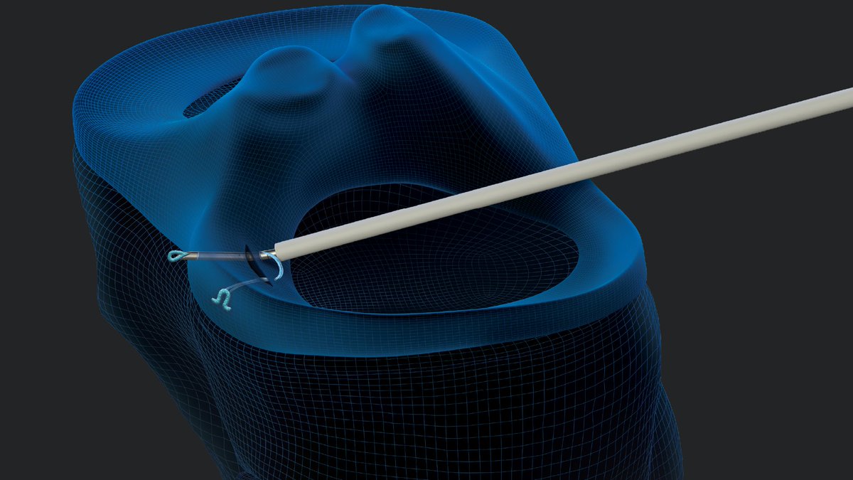 ArthrexMedEd's tweet photo. In today’s #WhatsNewAtArthrex, Aaron J. Krych, MD, reviews a biomechanical study of the primary fixation and cyclic performance of all-inside and inside-out meniscus repairs. Watch and view the study: https://t.co/ckNEVKSHMi
#Arthrex #Knee #FiberStitch #MeniscalRepair #AJSM https://t.co/i9Fzj99zdX