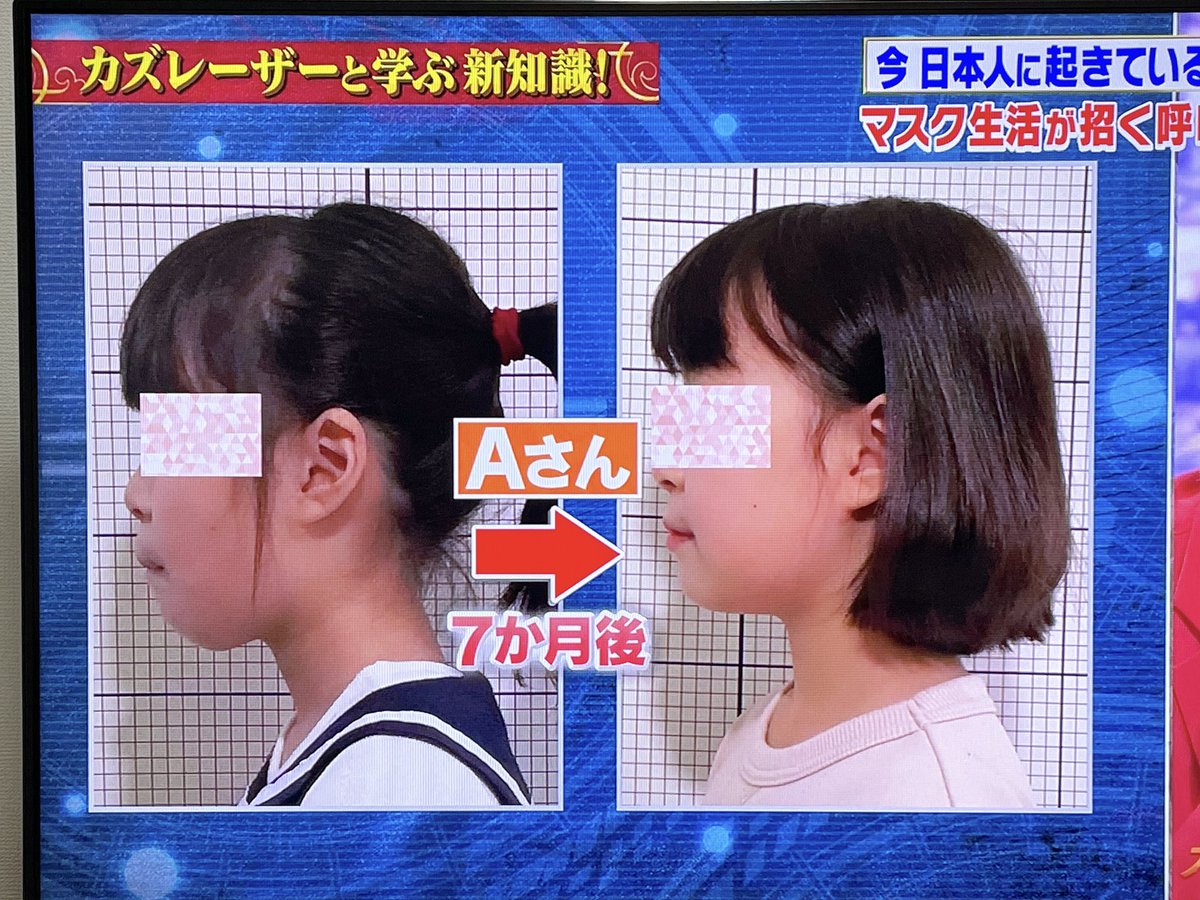 Suzutan365DT's tweet photo. 口呼吸か鼻呼吸かでこんなにも顔が変わってくるなんて🙄日本人は口呼吸してる人が多く、口呼吸だと顔が伸びるだけでなくIQの低下にも繋がるらしい。 12歳まではこのくらい大きな変化が出るみたい。12歳までにこの知識が欲しかったな。そしたらこんなでかい顔に悩むこともなかったのに・・・🥲 https://t.co/xWZDXAXN55