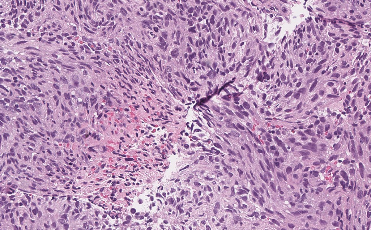 Male in his 60s with anterior mediastinal mass. Negative for pancytokeratin, muscle markers, PAX8, and STAT6.

#PathTwitter #ThoracicPath #pulmpath #BSTpath #pathology