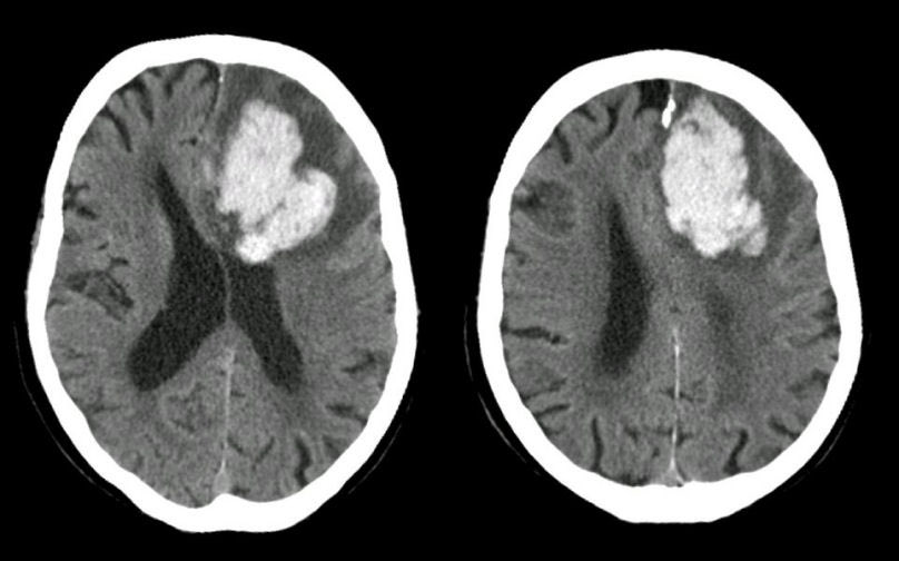 كتكملة للسلسلة الماضية بتكلم هالمرة عن نزيف الدماغ 🩸 🧠