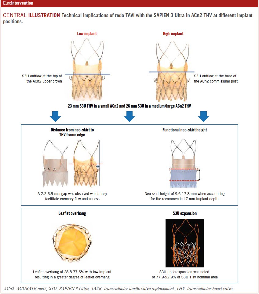 🆕 Placement of an S3U THV within an index ACn2 THV results in an acceptable functional neo-skirt height with no significant compromise to the S3U valve function and mild-to-moderate leaflet overhang, regardless of the implant depth. #EAPCI  ow.ly/84N650Mm6ph