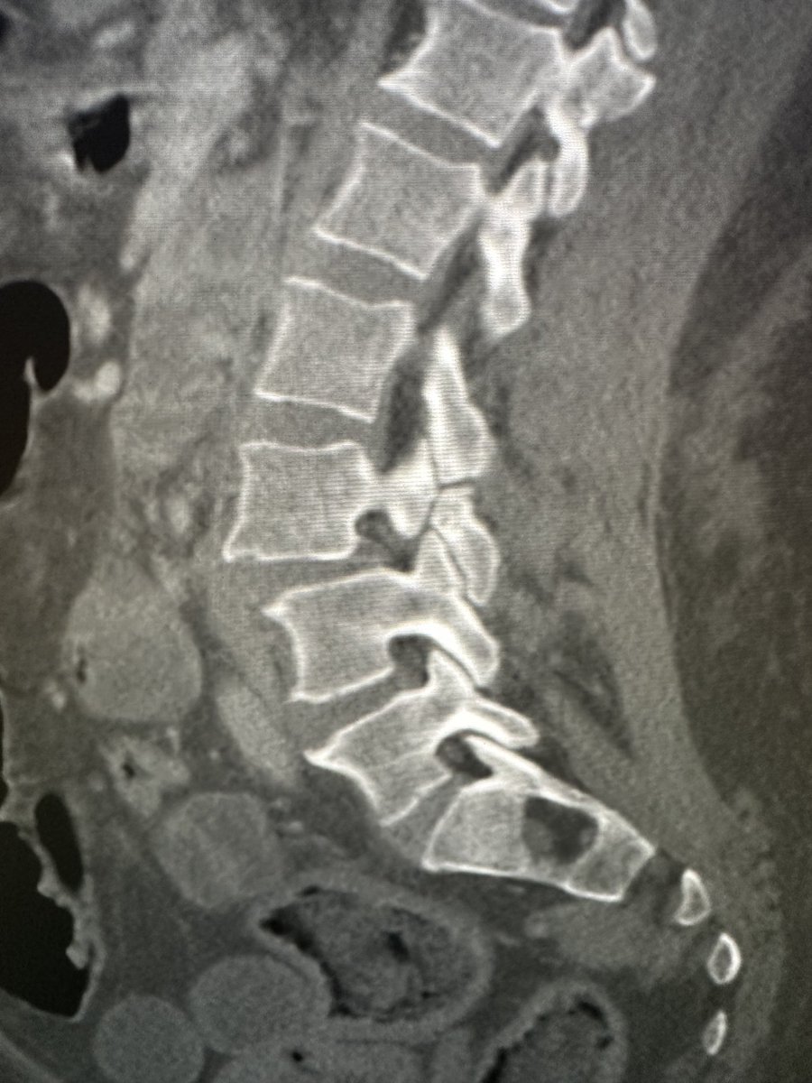 Relatively uncommon level for the spondylolysis. L3.