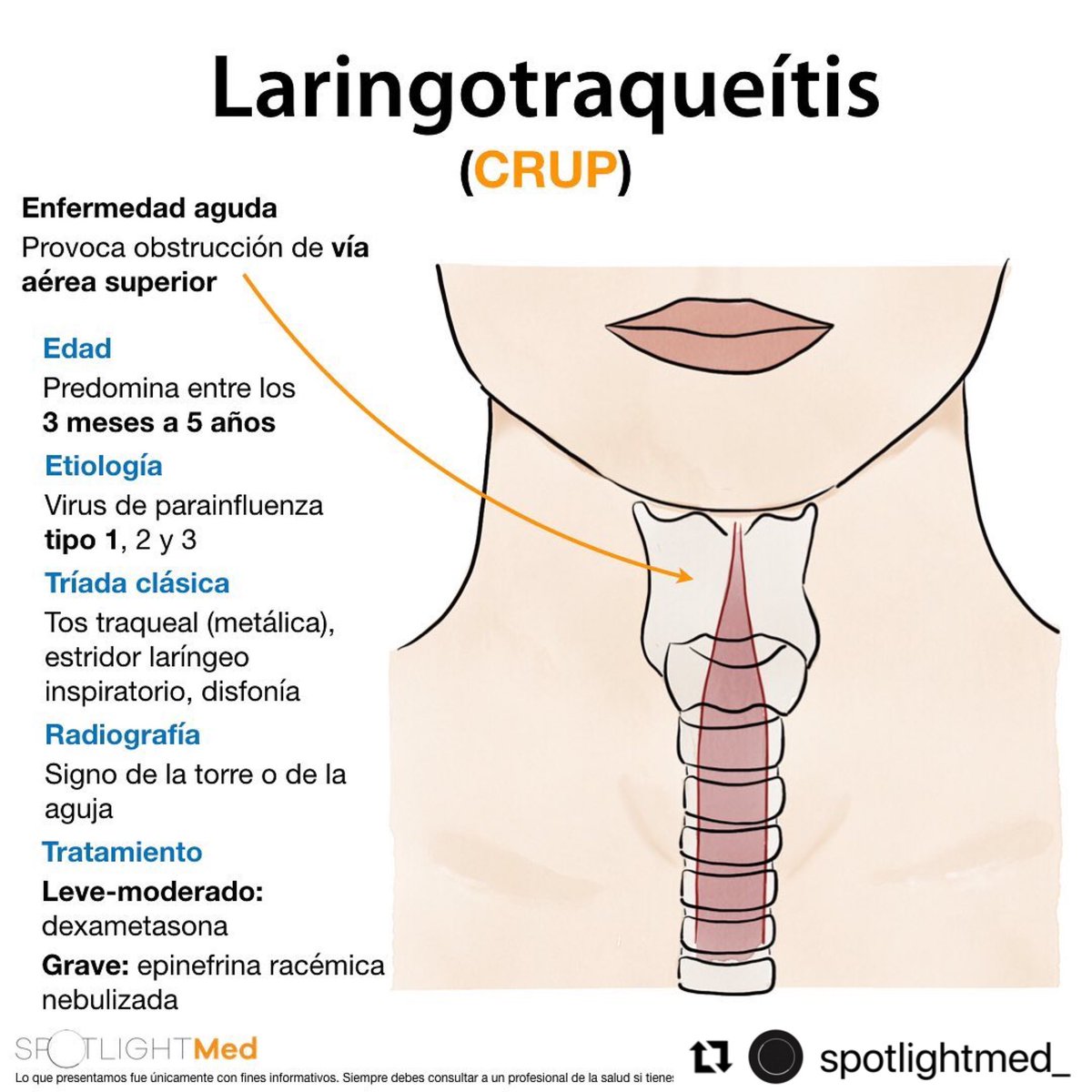 Laringotraqueítis (Crup) 😷
#Spotlightmed #spotlight #spotlightmedicine #medschool #medlife #medstudent #mip #mpss #enarm #medstudentlife #laringotraqueitis #pediatria