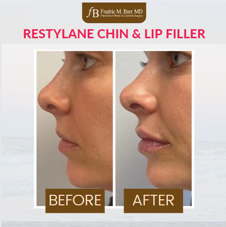 It's #TransformationTuesday!✨

Questions or Want to Schedule an Appointment? 
📲 Call (561) 823-1179

#PalmBeachPlasticAndCosmeticSurgery #beforeandafter #PalmBeach #transformation #DoctorPalmBeach #restylane #LipFiller #ChinFiller