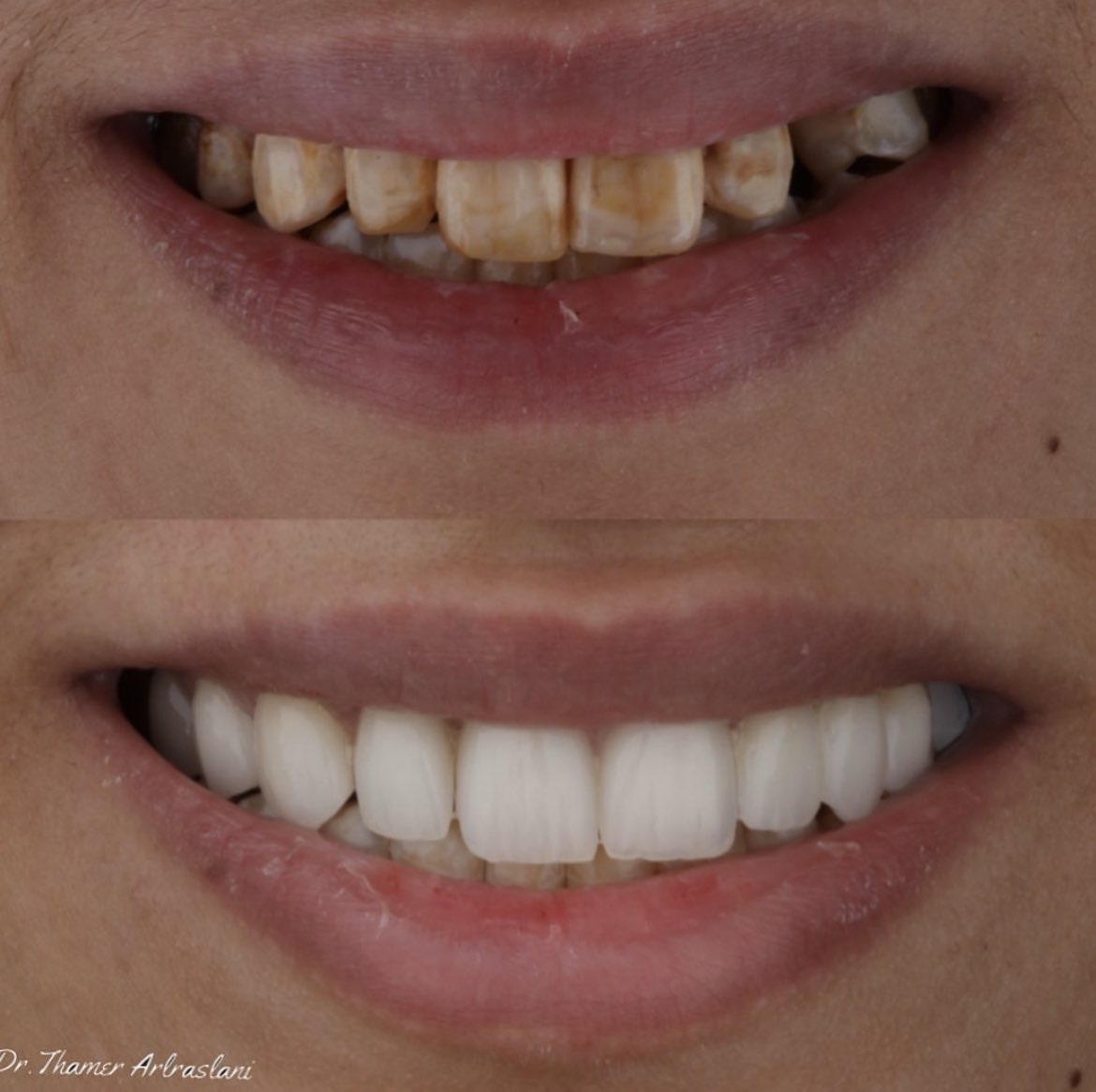 Smile makeover 🍃🤍 lab work by @mohammad_dental

🦷 by : <a href="/alaswad_t/">Dr.Thamer</a>