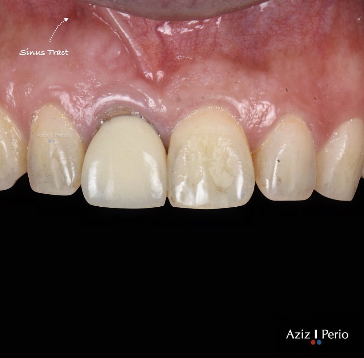 dentiscope's tweet photo. 🇺🇸Part1: A long story behind this tooth!
The pt came to see me after 2 failed RCT and another failed apicoectomy.
The Endodontist referred her after noticing a crack at the apical part of the tooth via microscope!
Since then, https://t.co/gvHws2Ngxm