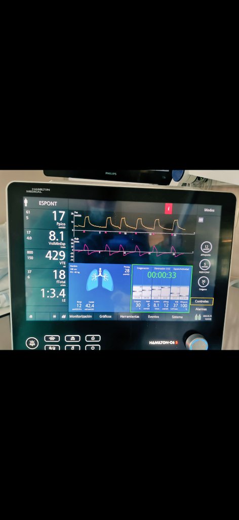 Pre-post sesión de FT respiratoria en paciente crítico 🫁🫀
 <a href="/vyyto/">Xavier Bigas</a> <a href="/FisioRespiVH/">Cardiorespiratory & Critical Care Physios Group.</a>
No sólo movilizamos al paciente. 
#secreciones #humidificación #VMI #tubuladura #fisioterapiaenUCI