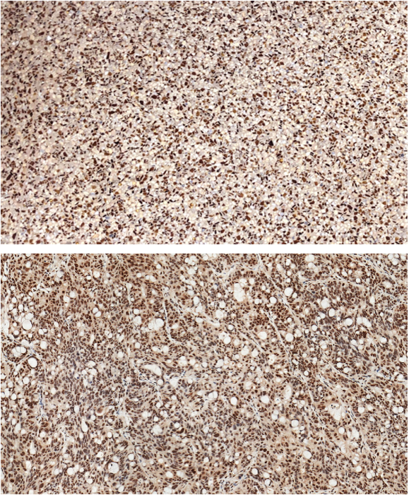 When the floor tiles start looking like #tumor #histology, it's time to take a break from the microscope I guess? 😛
#immunohistochemistry
(for those who might wonder, the floor is the top image)
