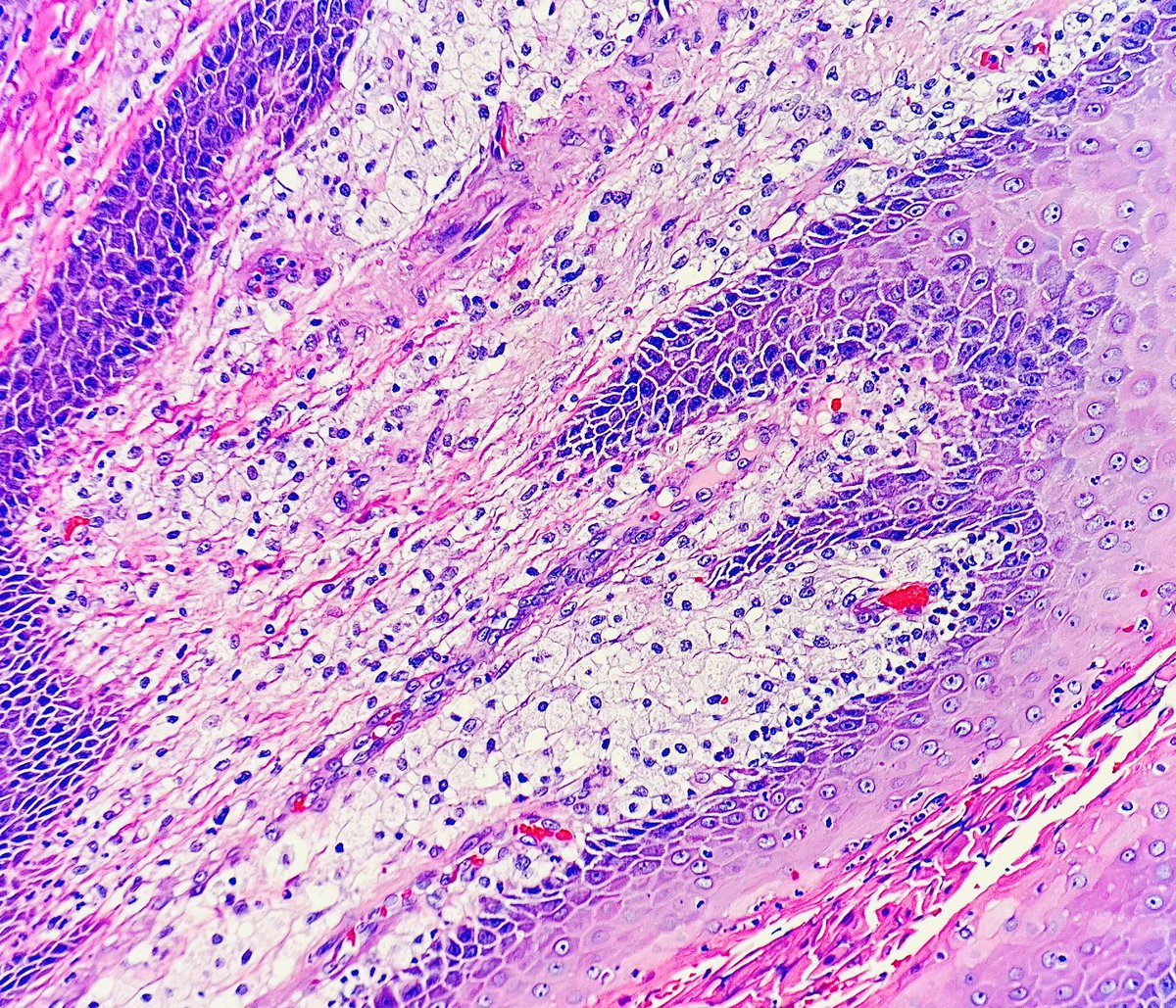 Adding closer picture 🏹 Foamy macrophages within connective tissue papillae 🏹No epithelial atypia 🏹Acute and chronic inflammatory cells 🏹 This is Verruciform Xanthoma #PathTwitter #dermtwitter #dermpath
