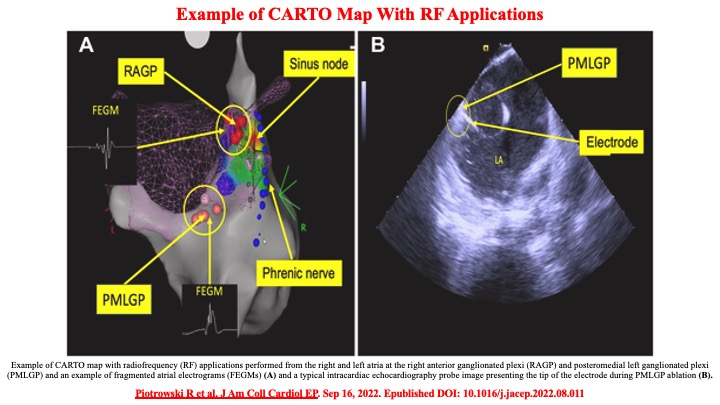 Raviele Antonio (@drraviele) on Twitter photo 📌 RCT in pts with VVS
👉 Cardioneuroablation compared to optimal nonpharmacologic Tx signif. ⬇️ syncopal recurrences: 8% vs 54% at 2-y fu
#vasovagalsyncope #CardioTwitter <a href="/MDTolgaAksu/">Tolga Aksu, MD</a> <a href="/DrRoderickTung/">Roderick Tung</a> <a href="/JagSinghMD/">Jag Singh</a> <a href="/JonPicciniSr/">Jonathan Piccini, MD, MHS</a> <a href="/DhirajGuptaBHRS/">Prof Dhiraj Gupta</a> <a href="/CarlChiefCard/">Carlos A Morillo</a> <a href="/rdschaller/">Robert Schaller</a> <a href="/EJSMD/">Edward J Schloss MD</a> 📌 RCT in pts with VVS
👉 Cardioneuroablation compared to optimal nonpharmacologic Tx signif. ⬇️ syncopal recurrences: 8% vs 54% at 2-y fu
#vasovagalsyncope #CardioTwitter <a href="/MDTolgaAksu/">Tolga Aksu, MD</a> <a href="/DrRoderickTung/">Roderick Tung</a> <a href="/JagSinghMD/">Jag Singh</a> <a href="/JonPicciniSr/">Jonathan Piccini, MD, MHS</a> <a href="/DhirajGuptaBHRS/">Prof Dhiraj Gupta</a> <a href="/CarlChiefCard/">Carlos A Morillo</a> <a href="/rdschaller/">Robert Schaller</a> <a href="/EJSMD/">Edward J Schloss MD</a>