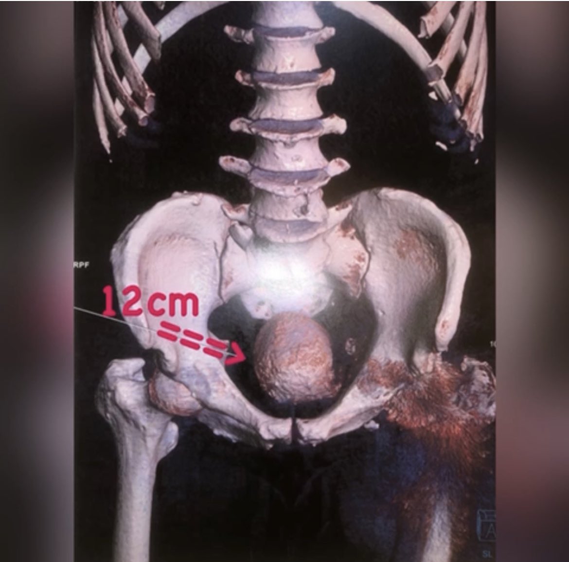 12cm bladder stone removed by endoscopy in 70 years old patient who refused open surgery