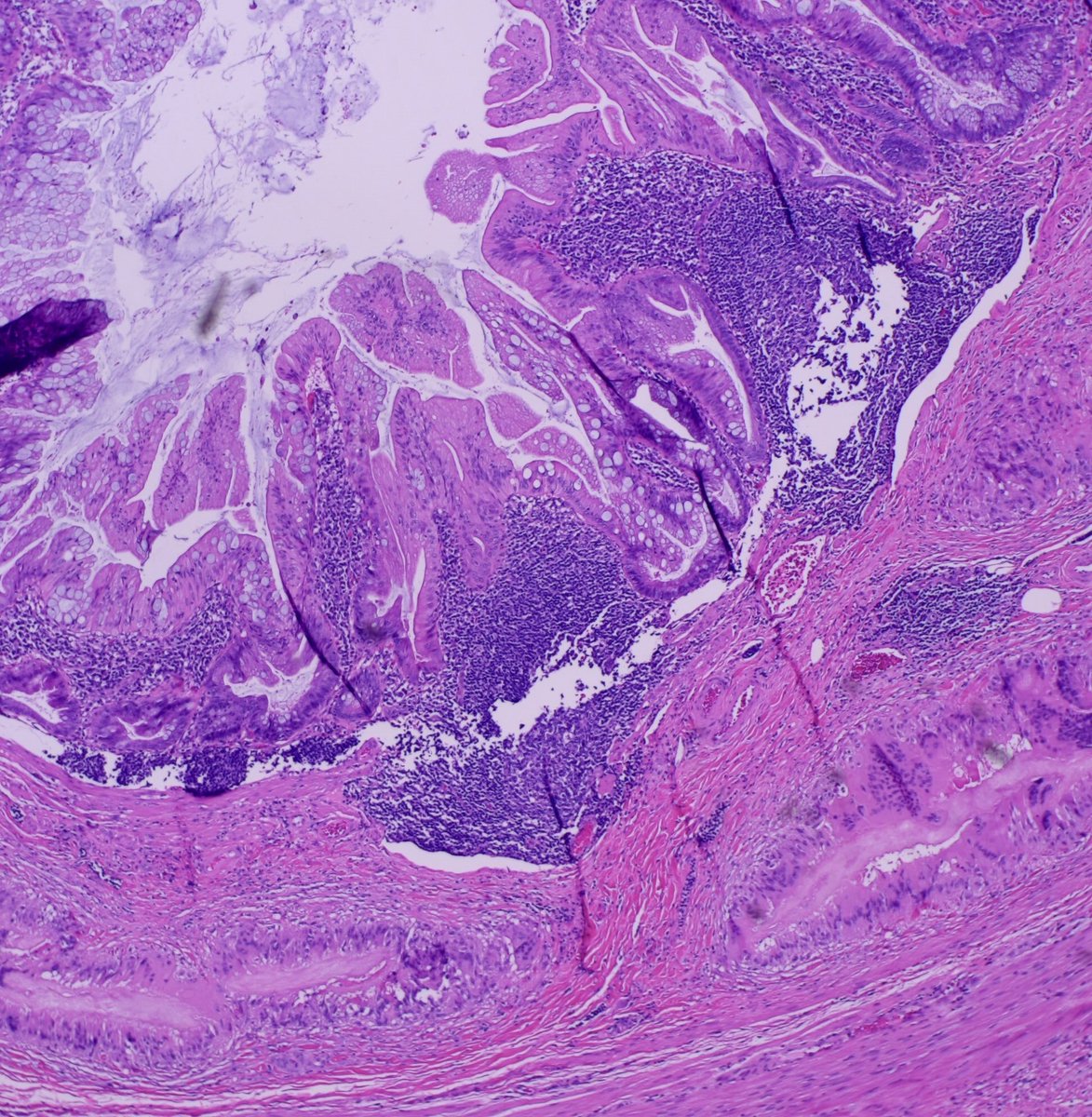 Teclis82's tweet photo. #GIpath #Surgpath #pathresidents #pathtwitter

A section from an appendix in a 48 year old man.

#Pathresidents:  Want to speculate on the clinical history? https://t.co/dviypJ4o3M