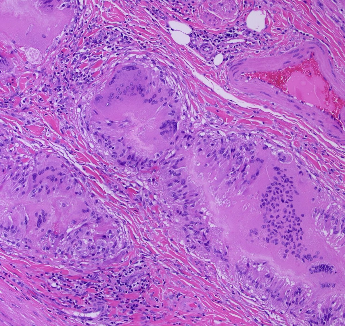 Teclis82's tweet photo. #GIpath #Surgpath #pathresidents #pathtwitter

A section from an appendix in a 48 year old man.

#Pathresidents:  Want to speculate on the clinical history? https://t.co/dviypJ4o3M