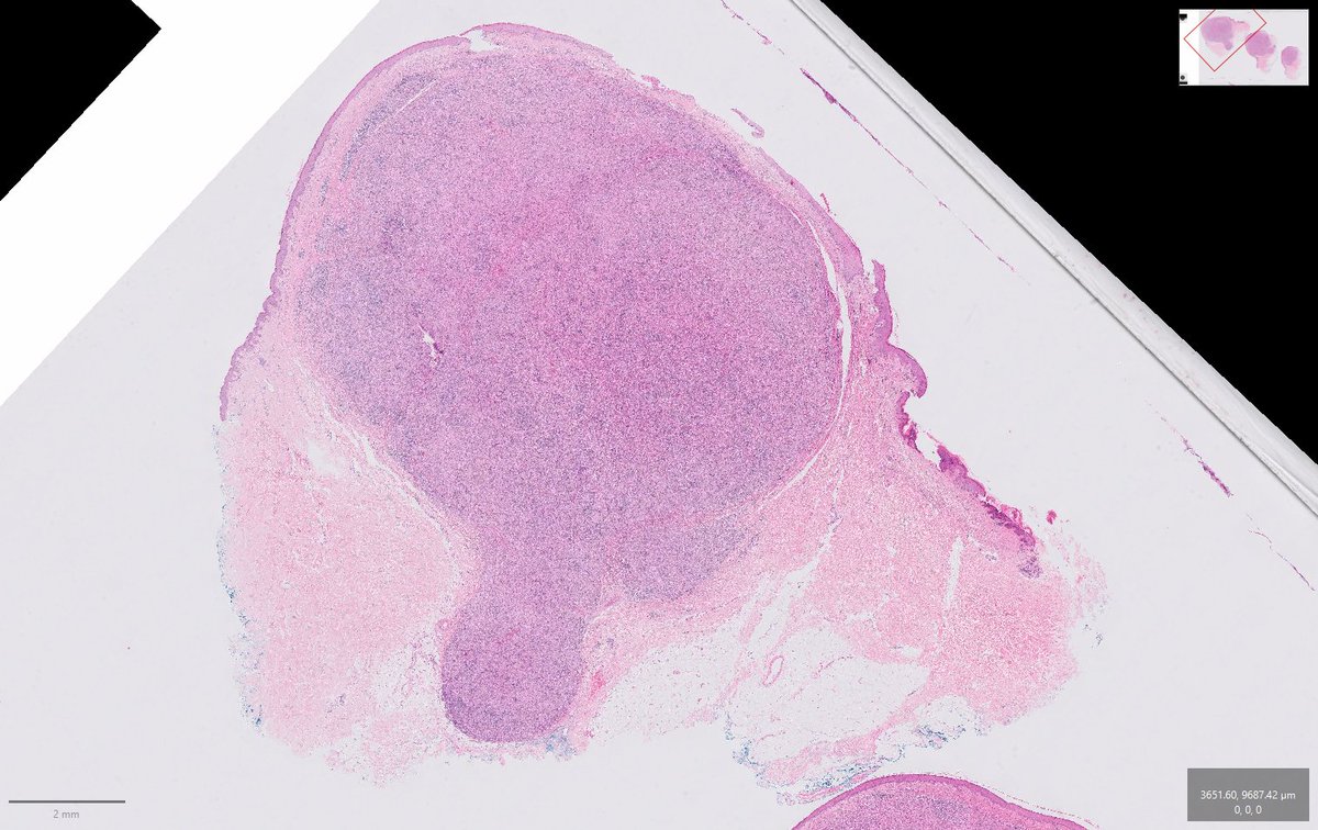 LukeBeauMBBS's tweet photo. Throwing this case out there for any opinions. Has been a tough one in the dept. 75F clavicular lesion, ?BCC. No sig Hx. Scanned links to follow. #pathology #dermpath @JMGardnerMD @mccalmo @TristanRutland7 https://t.co/WfCHtpPGst