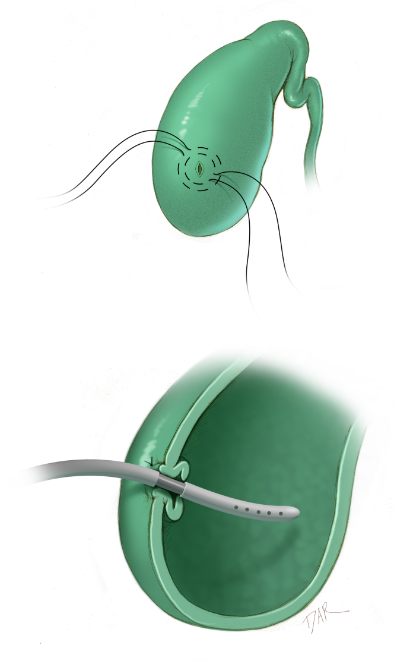 TheJNS's tweet photo. #NeurosurgicalAtlas: Chapter describing how to perform a ventriculo-gallbladder shunt!
https://t.co/uJiTeLYnM9 https://t.co/X5KoUnbZ3F