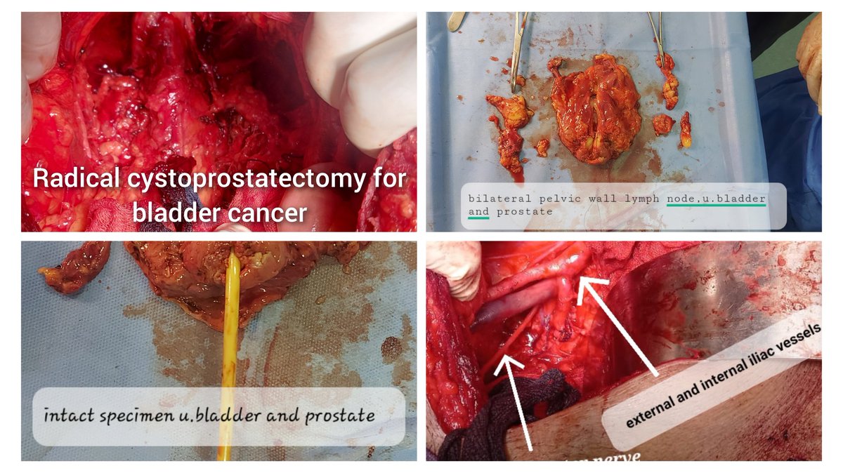 @RamPathakMD @AshTewariMD @MayoFL_UrolRes I'm doing open radical cystoprstatectommy...done in last week