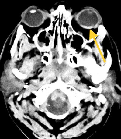 daniel_gewolb's tweet photo. Terson syndrome refers to vitreous or retinal hemorrhage in the setting of subarachnoid hemorrhage. Possible mechanism is thought to be related to sudden increased intracranial pressure resulting in increased retinal venous pressure. This is a poor prognostic sign
@JosephGiampaDO https://t.co/E6CUoTMvhT