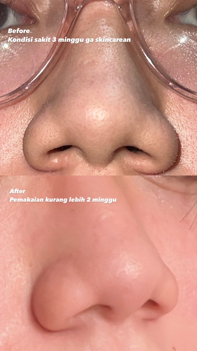 adellianur's tweet photo. SUMPAH aku menemukan lagi combo peeling yg gentle dan bisa bikin tekstur jadi lebih alus + menghempaskan komedo di idung aku🥹

Nih buktinya, aku udah coba sendiri😭👍🏻
#racuninskincare #AkudanAirinBeauty #airinbikingloweeng2023 https://t.co/0s5ZfTMdgr
