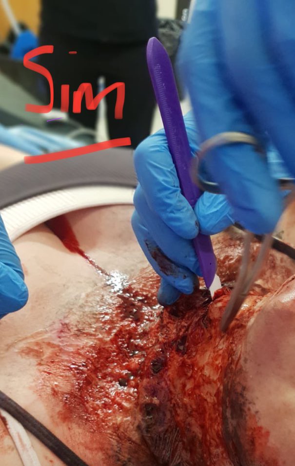 Obidoc's tweet photo. So they have the basic airway skills but how do you take them to the next level? #CRM #Advancedskills #reducingstress #improvingsafety #airwaymanagement - hear how #ATACC develop those skills and build safer teams @Assoc_Anaes #WSM2023 https://t.co/Xu8Lx4xHQw