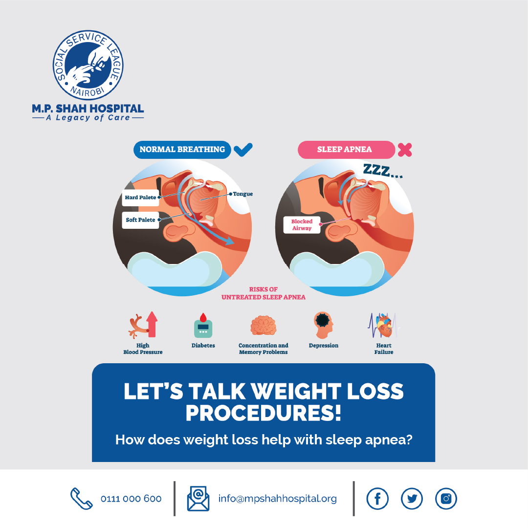 MPShahhospital's tweet photo. LET’S TALK WEIGHT LOSS PROCEDURES! How does the weight loss help with sleep apnea?
#weightlossprocedures
#LegacyofCare
#mpshahhospital
#weightloss https://t.co/rWuzKlHPi8
