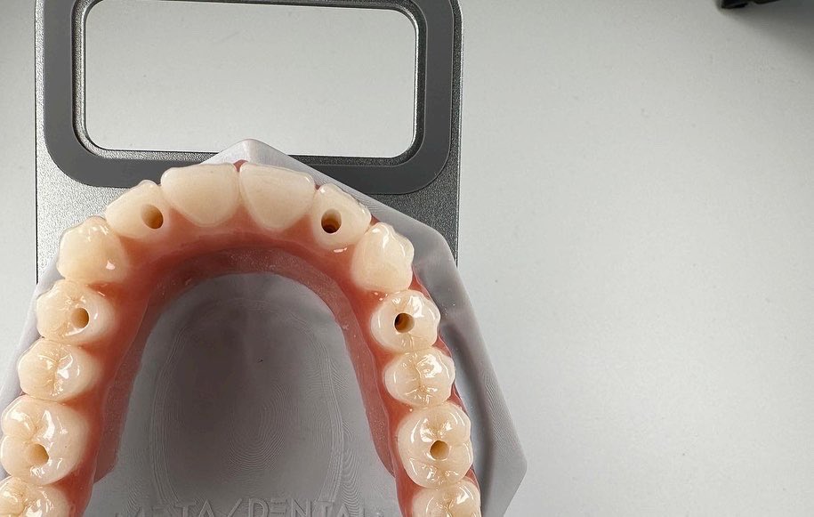 MetaDentalDE's tweet photo. #meta-dental
#implant
#allon6
#zirconia https://t.co/99ODgQP9IC
