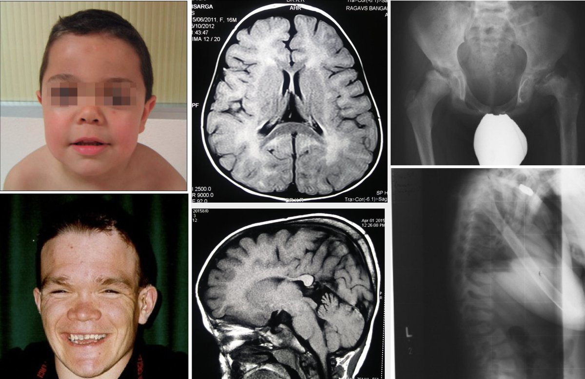 IsabelSolares7's tweet photo. Además de las MUCOPOLISACARIDOSIS 🧬
¿Qué enfermedad tenemos que sospechar?

-Otitis recurrentes e hipoacusia👂

-Rasgos toscos (frente prominente, raiz nasal plana,macrocefalia...)👃 

-Regresión cognitiva 🧠

-Afect.esquelética (disostosis múltiple, displasia de cadera...)🦴 https://t.co/Qj50YDGY2a