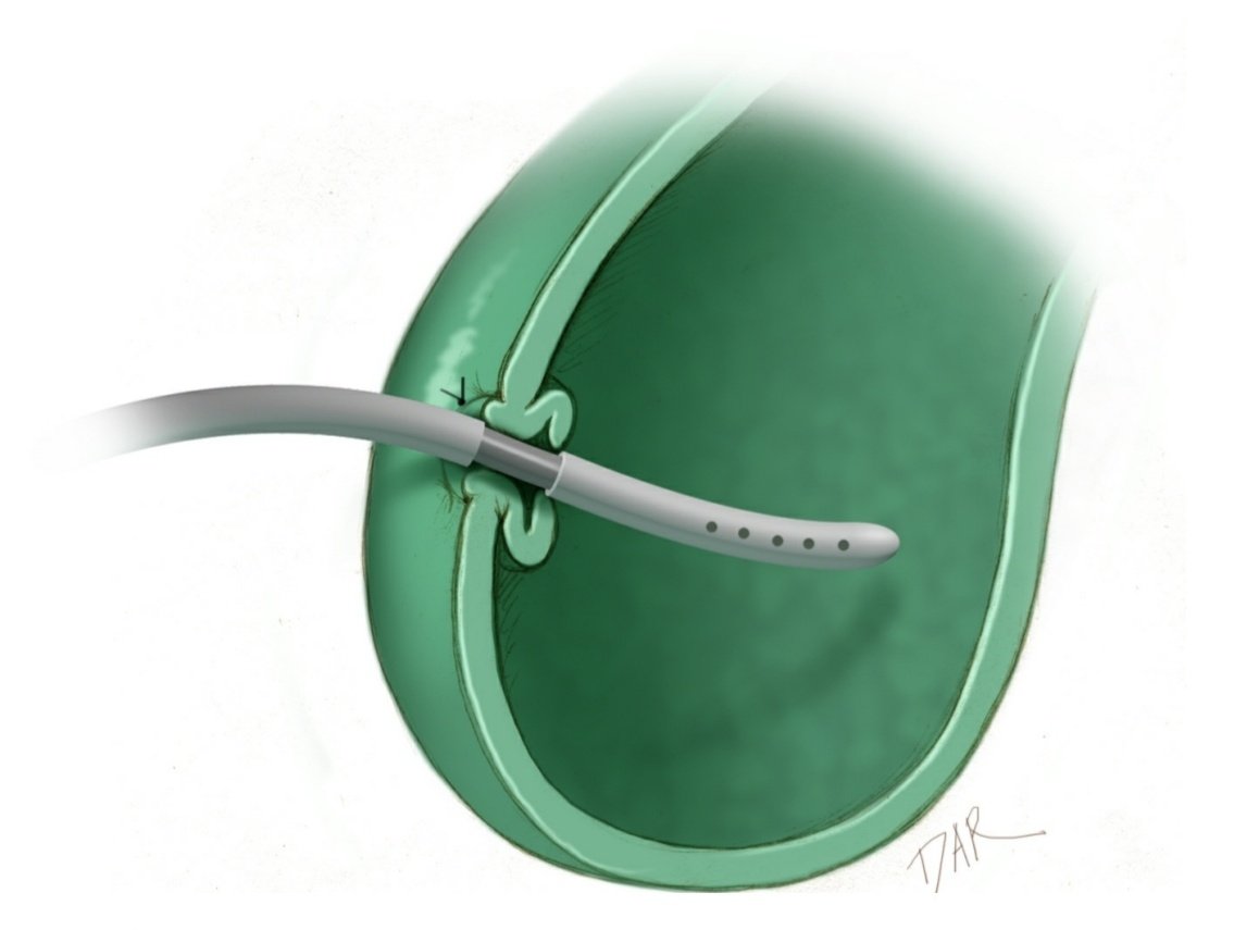 Vean esta imagen del <a href="/TheJNS/">Journal of Neurosurgery</a>, drenar los ventrículos cerebrales a la vesícula biliar. El artículo lo dice muy bien "puede hacerse, porque en condiciones normales, la bilis es estéril". 🤯 #Cirugía #Cirujanos