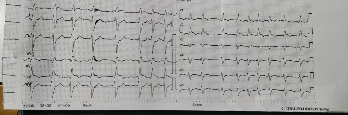 dr_bavlos's tweet photo. 60 year old male, diabetic and smoker
Complaint: minimal upper abdominal pain
Your comment on ECG?

#CardioTwitter https://t.co/jgTj8Dl3XQ
