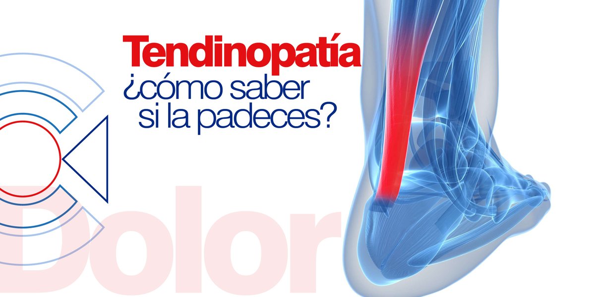 Cedemmerida_ca's tweet photo. ¿Conoces que es una #tendinopatia🤔? Las tendinopatías se refieren al conjunto de patologías que afectan a la estructura tendinosa; clasificándose en: #paratendinosis, #tendinosis y #entesitis😯. https://t.co/z2hr7rvgCD
