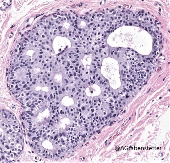 Breast snapshot: DCIS 🔬
#pathtwitter #pathology #bcsm #breastcancer